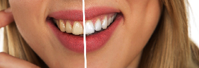 Wybielanie zębów, czyli jak uzyskać piękny i biały uśmiech?